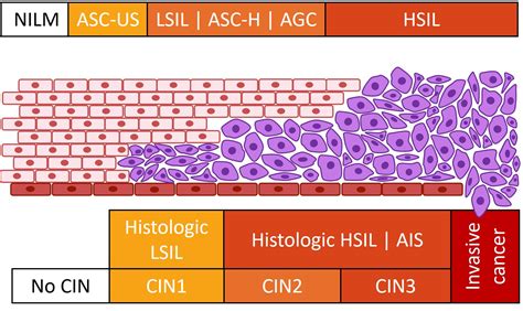 CIN 3 is also called carcinoma-in-situ. . Cin1 to cancer in 6 months